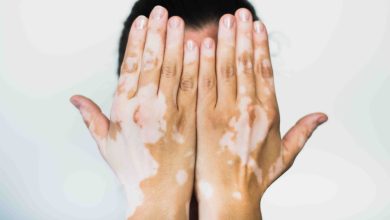 Traitement du vitiligo