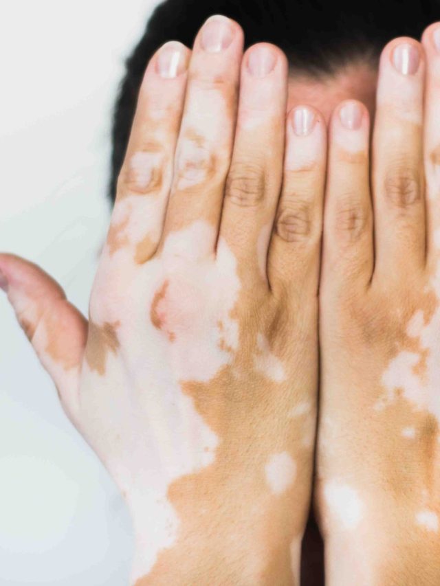 Traitement du vitiligo : un nouveau médicament approuvé en Europe