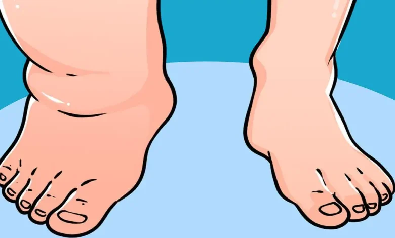 Pieds et chevilles gonflés