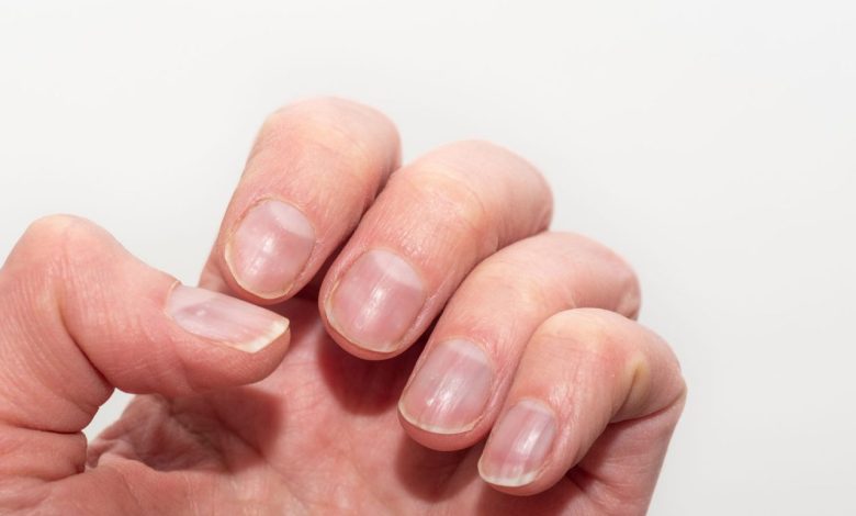 3 Solutions Naturelles pour Fortifier Vos Ongles Fragiles