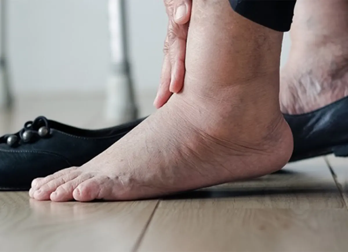 Pieds et chevilles gonflés