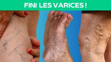 Se débarrasser définitivement des varices.