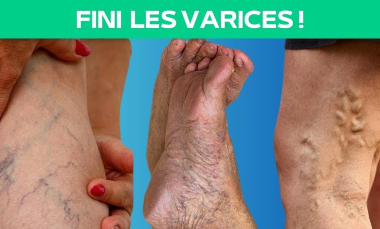 Se débarrasser définitivement des varices.