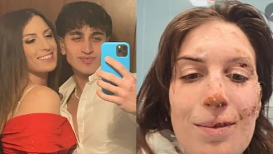 Eleonora, 29 ans, survivante de Crans-Montana, dévoile son visage brûlé depuis l’hôpital