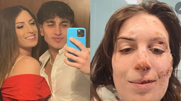 Eleonora, 29 ans, survivante de Crans-Montana, dévoile son visage brûlé depuis l’hôpital