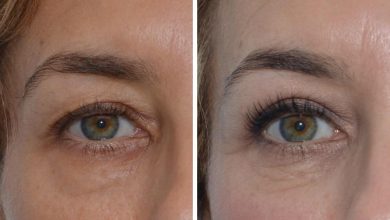 Comment Enlever les Poches Sous les Yeux