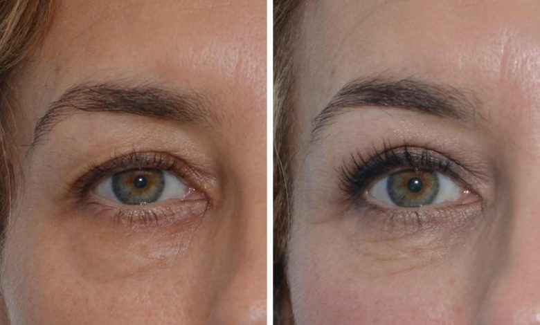 Comment Enlever les Poches Sous les Yeux
