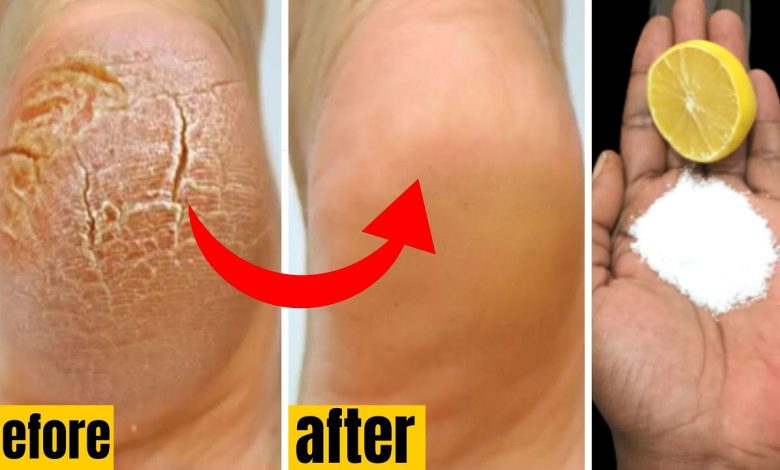 Comment se débarrasser des cors, des callosités et des champignons des pieds pour toujours et nature