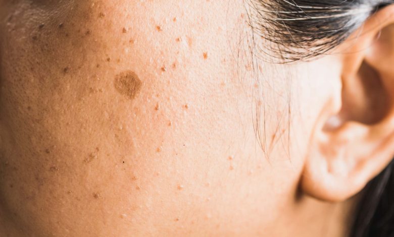 taches brunes sur la peau