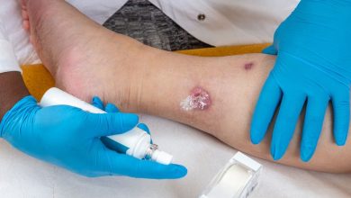 Maladie de Verneuil : tout ce qu'on ne vous dit pas sur l'Hidradénite Suppurée