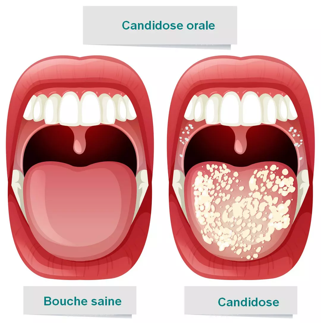 Mycose de la bouche 