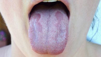Mycose de la bouche