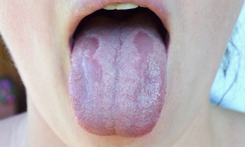 Mycose de la bouche