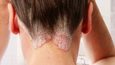 Psoriasis : pourquoi votre peau fait-elle une "Crise de nerfs" et comment la calmer ?