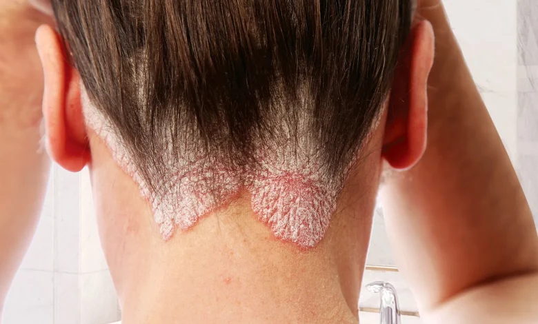 Psoriasis : pourquoi votre peau fait-elle une "Crise de nerfs" et comment la calmer ?