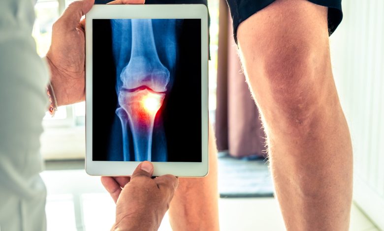 arthrose du genou