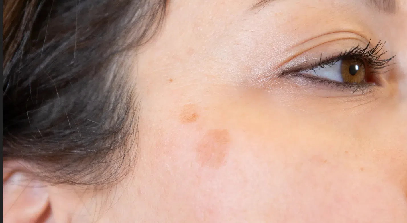 Éliminez Les Taches Brunes Sur Votre Visage
