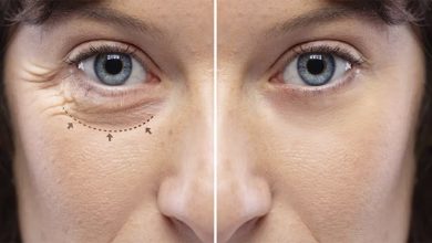 Le bicarbonate de soude présente de nombreux avantages pour la santé et peut également être appliqué dans les astuces de beauté. Si vous souhaitez éclaircir un peu votre peau, en particulier les cernes sous les yeux, vous pouvez utiliser le bicarbonate comme remède à la maison pour y parvenir. C’est un truc qui peut être utilisé tant que vous n’avez pas la peau très sensible. Le bicarbonate de soude peut être utilisé pour éclaircir la peau du visage, du cou, des aisselles, des coudes, des genoux, des articulations et même pour les cernes. Des précautions particulières doivent être prises lors de l’utilisation de cette substance sur le visage. Voici pourquoi le bicarbonate de soude peut aider à blanchir ces parties de la peau. Le bicarbonate de sodium peut aider à exfolier et à éliminer les cellules mortes de la peau et à révéler une peau plus lumineuse. Les deux composés du bicarbonate de sodium, le neutralisant du pH et du sodium, aident à réparer et à éclaircir la peau. Le bicarbonate de sodium nettoie la peau en profondeur en absorbant l’excès d’huile et en éliminant la saleté. Le bicarbonate de soude et l’inflammation: Il semble qu’aujourd’hui, peu importe où nous allons, entendre parler de l’inflammation est déjà très courant. Être enflé est déjà quelque chose pour laquelle beaucoup de gens luttent aujourd’hui. Et ce n’est pas surprenant, car notre mode de vie est devenu de plus en plus excessif face à des niveaux de stress qui deviennent insondables, avec des allergènes et des toxines dans notre environnement, une mauvaise alimentation avec des régimes hautement transformés, en plus de nombreux autres médicaments et l’insomnie. Tous ces facteurs augmenteront l’inflammation, car ils éliminent les minéraux alcalins du corps. Les ions bicarbonates neutralisent les conditions acides nécessaires à toutes ces réactions inflammatoires. Par conséquent, le bicarbonate de sodium est bénéfique dans le traitement d’un large éventail de symptômes inflammatoires. Pour réduire éventuellement l’inflammation, le corps doit être alcalinisé, ce qui signifie que les niveaux de CO2 et d’oxygène doivent être augmentés. Le bicarbonate de sodium augmente le pH et réduit l’inflammation dans le corps. Notre visage et en particulier nos yeux sont l’une des parties que chaque femme veut garder moins enflammées. Ces sacs sous les yeux sont pour tous un défi à relever si nous cherchons à être meilleurs. Cette fois, nous vous donnerons une recette simple qui vous aidera à réduire cette inflammation. Vous ne verrez plus l’aspect enflammé de la fatigue, de l’insomnie et du stress sur votre visage. Ce masque étonnant vous aidera à vous débarrasser des poches sous les yeux et des cernes presque instantanément. Recette: – Mélangez une cuillère à café de bicarbonate de soude dans une tasse de thé chaud ou d’eau chaude. – Trempez deux disques de coton dans du bicarbonate de soude / eau (thé) et placez-les sous vos yeux. Laissez les disques de coton pendant 15-30 minutes. – Rincer et appliquer de l’huile de noix de coco. Faites cela quotidiennement et dans deux semaines, vous verrez les bons résultats. Les cernes et les poches sous les yeux disparaîtront à jamais.