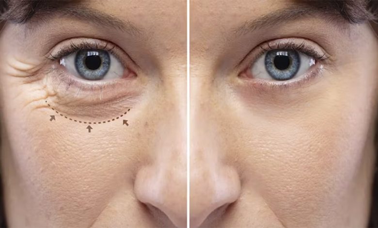 Le bicarbonate de soude présente de nombreux avantages pour la santé et peut également être appliqué dans les astuces de beauté. Si vous souhaitez éclaircir un peu votre peau, en particulier les cernes sous les yeux, vous pouvez utiliser le bicarbonate comme remède à la maison pour y parvenir. C’est un truc qui peut être utilisé tant que vous n’avez pas la peau très sensible. Le bicarbonate de soude peut être utilisé pour éclaircir la peau du visage, du cou, des aisselles, des coudes, des genoux, des articulations et même pour les cernes. Des précautions particulières doivent être prises lors de l’utilisation de cette substance sur le visage. Voici pourquoi le bicarbonate de soude peut aider à blanchir ces parties de la peau. Le bicarbonate de sodium peut aider à exfolier et à éliminer les cellules mortes de la peau et à révéler une peau plus lumineuse. Les deux composés du bicarbonate de sodium, le neutralisant du pH et du sodium, aident à réparer et à éclaircir la peau. Le bicarbonate de sodium nettoie la peau en profondeur en absorbant l’excès d’huile et en éliminant la saleté. Le bicarbonate de soude et l’inflammation: Il semble qu’aujourd’hui, peu importe où nous allons, entendre parler de l’inflammation est déjà très courant. Être enflé est déjà quelque chose pour laquelle beaucoup de gens luttent aujourd’hui. Et ce n’est pas surprenant, car notre mode de vie est devenu de plus en plus excessif face à des niveaux de stress qui deviennent insondables, avec des allergènes et des toxines dans notre environnement, une mauvaise alimentation avec des régimes hautement transformés, en plus de nombreux autres médicaments et l’insomnie. Tous ces facteurs augmenteront l’inflammation, car ils éliminent les minéraux alcalins du corps. Les ions bicarbonates neutralisent les conditions acides nécessaires à toutes ces réactions inflammatoires. Par conséquent, le bicarbonate de sodium est bénéfique dans le traitement d’un large éventail de symptômes inflammatoires. Pour réduire éventuellement l’inflammation, le corps doit être alcalinisé, ce qui signifie que les niveaux de CO2 et d’oxygène doivent être augmentés. Le bicarbonate de sodium augmente le pH et réduit l’inflammation dans le corps. Notre visage et en particulier nos yeux sont l’une des parties que chaque femme veut garder moins enflammées. Ces sacs sous les yeux sont pour tous un défi à relever si nous cherchons à être meilleurs. Cette fois, nous vous donnerons une recette simple qui vous aidera à réduire cette inflammation. Vous ne verrez plus l’aspect enflammé de la fatigue, de l’insomnie et du stress sur votre visage. Ce masque étonnant vous aidera à vous débarrasser des poches sous les yeux et des cernes presque instantanément. Recette: – Mélangez une cuillère à café de bicarbonate de soude dans une tasse de thé chaud ou d’eau chaude. – Trempez deux disques de coton dans du bicarbonate de soude / eau (thé) et placez-les sous vos yeux. Laissez les disques de coton pendant 15-30 minutes. – Rincer et appliquer de l’huile de noix de coco. Faites cela quotidiennement et dans deux semaines, vous verrez les bons résultats. Les cernes et les poches sous les yeux disparaîtront à jamais.