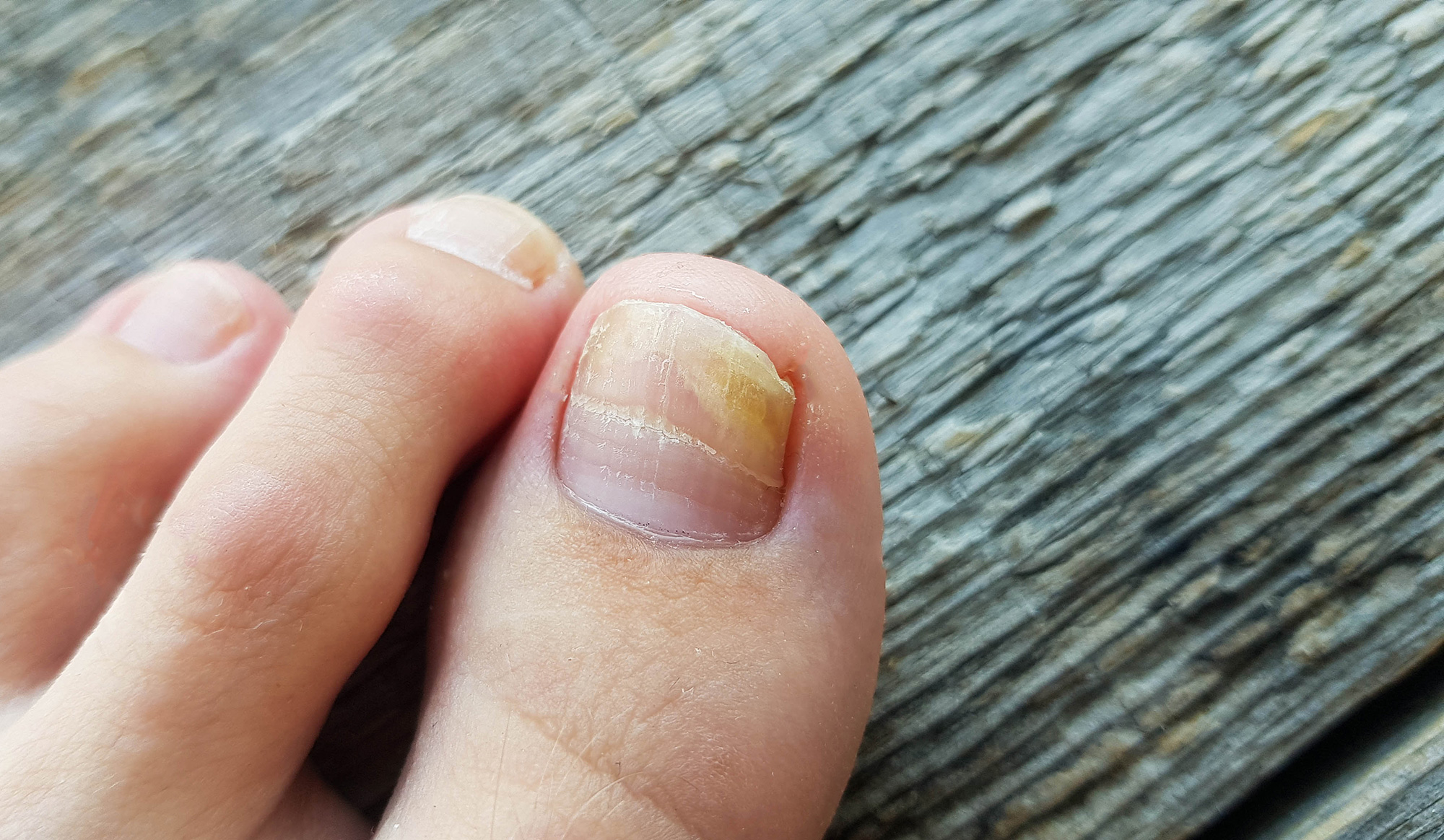 mycose des ongles de pieds