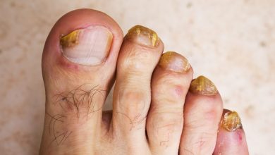 mycose des ongles de pieds
