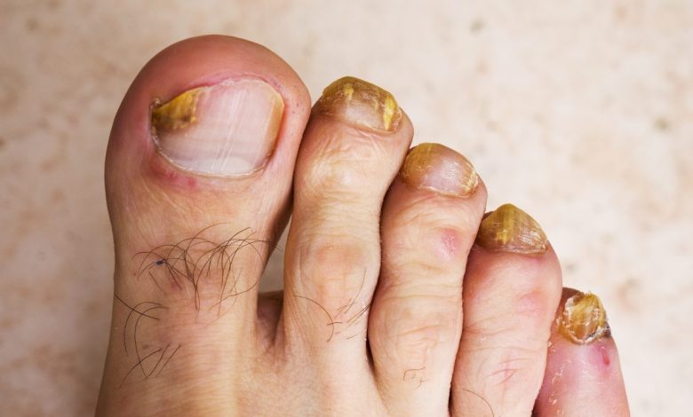 mycose des ongles de pieds