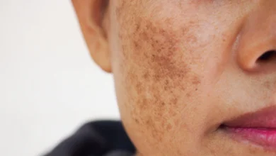 Éliminez Les Taches Brunes Sur Votre Visage