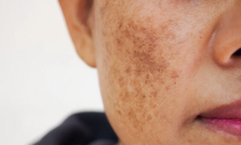 Éliminez Les Taches Brunes Sur Votre Visage