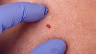 Points rouges sur la peau : Ne les ignorez plus, voici ce qu'ils disent vraiment de votre santé