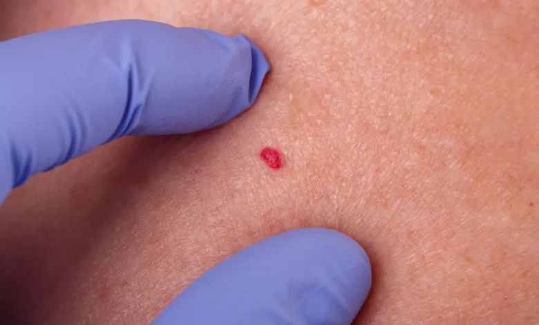 Points rouges sur la peau : Ne les ignorez plus, voici ce qu'ils disent vraiment de votre santé