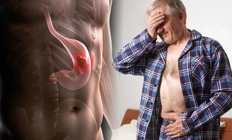 Cancer de l'estomac